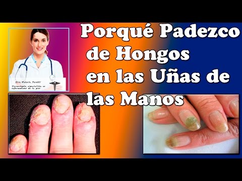 El aceite bate del hongo de las uñas Los medios públicos del hongo en los pies por el yodo
