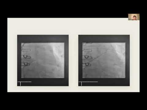 CVI Coronary Atherectomy Challenging Case Contest