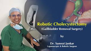 Robotic Cholecystectomy (Robotic Gallbladder Removal Surgery) by Dr. Samrat Jankar