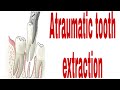 Use of a luxator to extract the root stumps, how to luxate and extract a tooth.