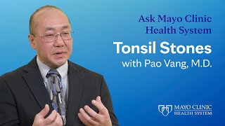 All About Tonsil Stones: Ask Mayo Clinic Health System