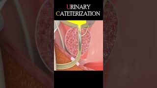 Urinary Catheterization Procedure #shorts