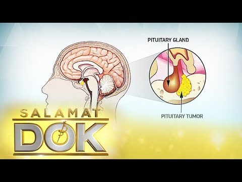 Salamat Dok: The medications and surgery for Gynecomastia