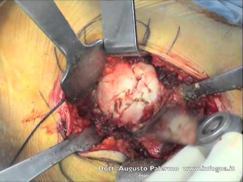 Notte mal di testa osteocondrosi Cervicale osteocondrosi toracica di un medico