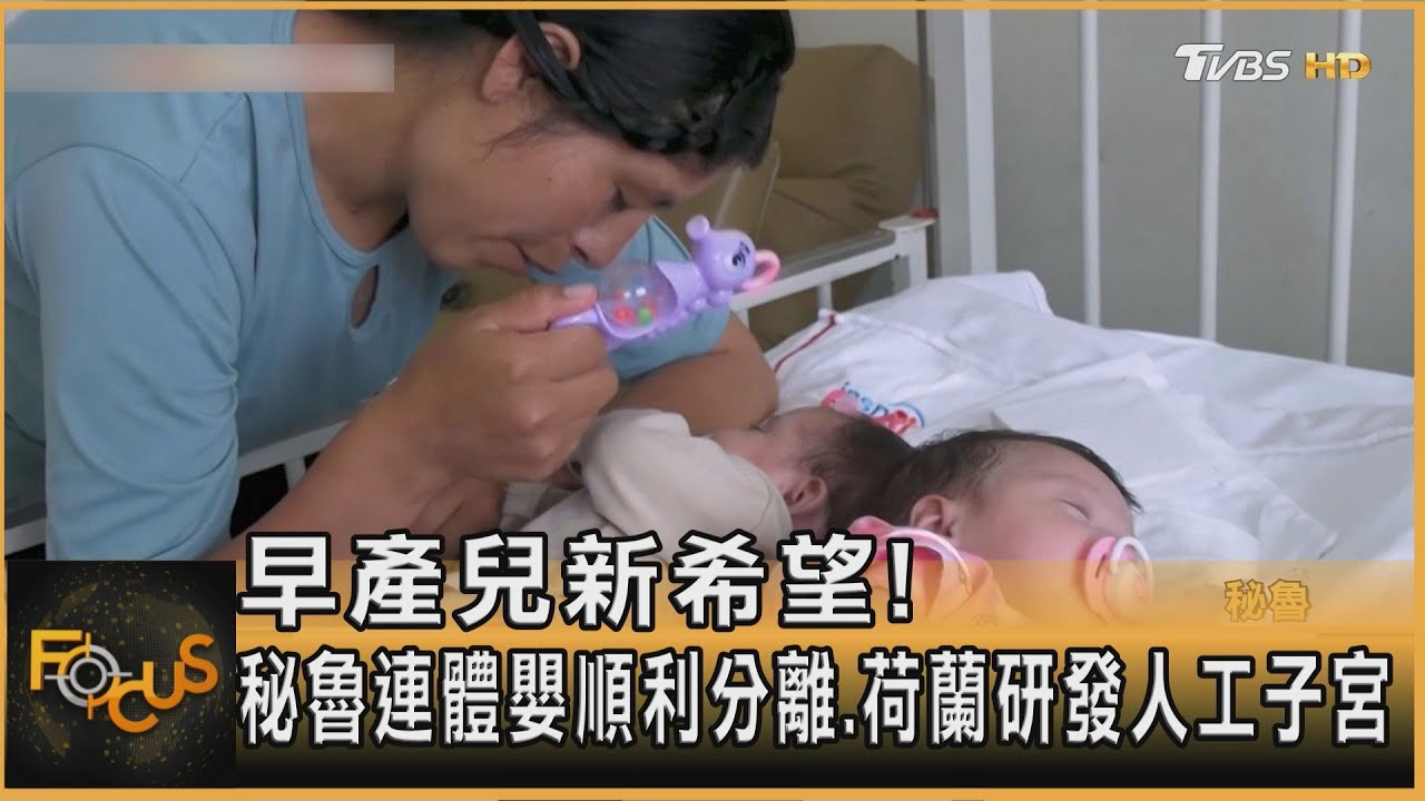 早產兒新希望!秘魯連體嬰順利分離 荷蘭研發人工子宮