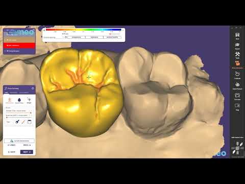 Aidite Exocad design guide: Single crown of prosterior teeth and Software introduced