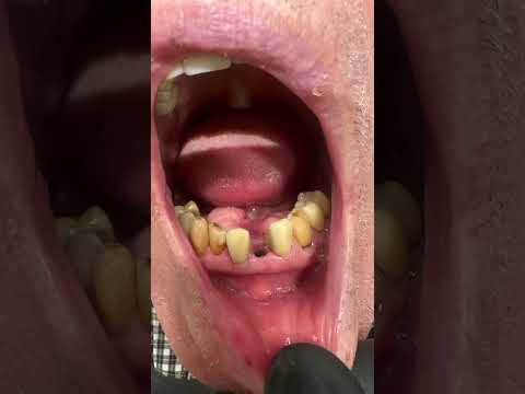 Dental Implants