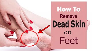 How to Remove Dead Skin on Your Feet at Home || Home Remedies for  Dead Skin Removal on Feet