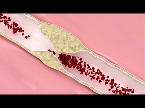 Aprendendo Fisiologia: Acidente Vascular Cerebral (por André F. Ludwig)