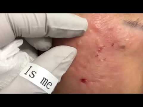Acne! Огромные угри! Давим! Огромные прыщи!