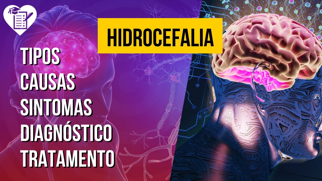 HIDROCEFALIA - Tipos de hidrocefalia, Causas, Sintomas, Diagnóstico, Complicações e Tratamento