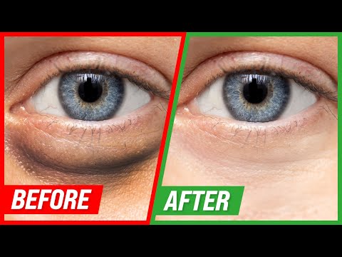 How To Get Rid of Eye Floaters – Dr Berg On Eye Floater Treatment