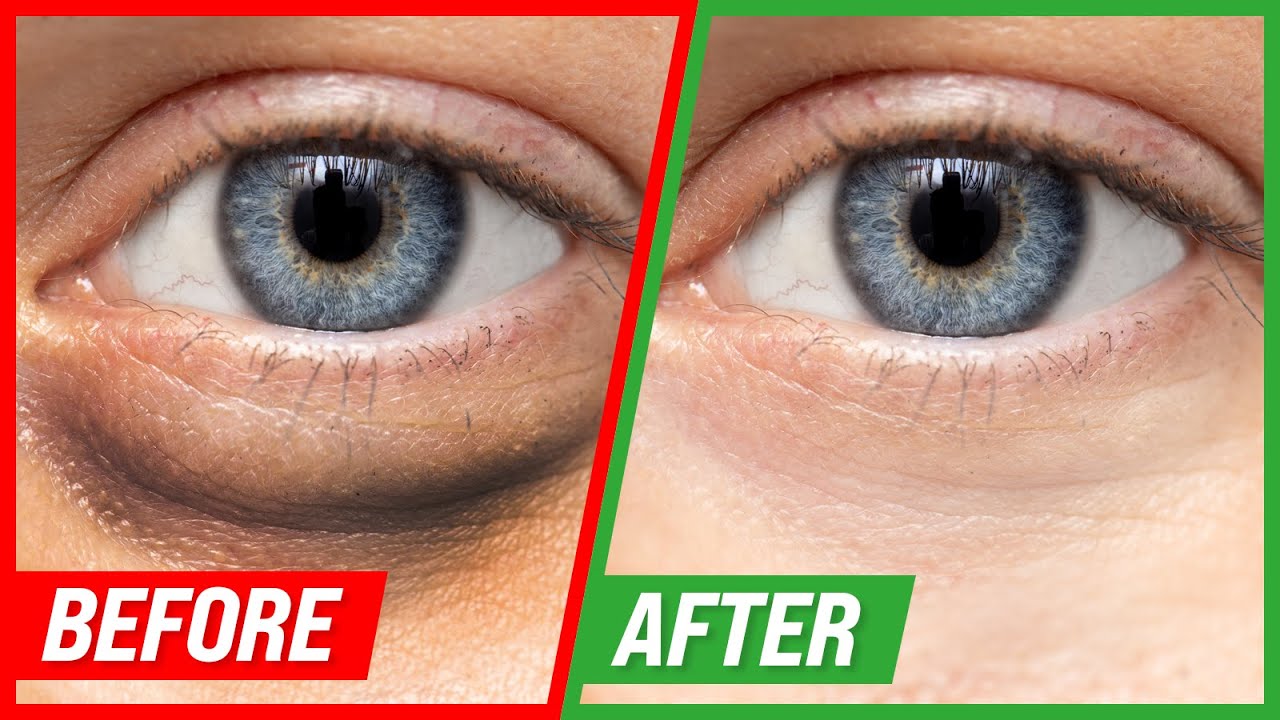 How to Get Rid of Puffy Eyes and Dark Circles Underneath the Eyes, Beauty Vigour