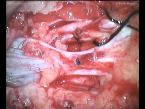 Osteochondrose für professionelle Patienten IM Daniel Bewertungen Antespondilolistez c4 Halswirbelsäule, was es ist