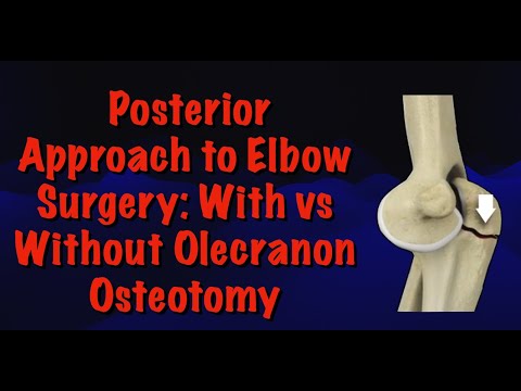 Posterior Approach to Elbow Surgery: With vs Without Olecranon Osteotomy | Dr Deepak Garg