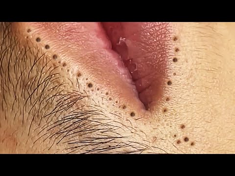 Blackhead removal Video #72 #Blackheads #blackheadsremoval #sebum