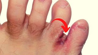 Como CURAR Frieira (de uma vez por todas!)