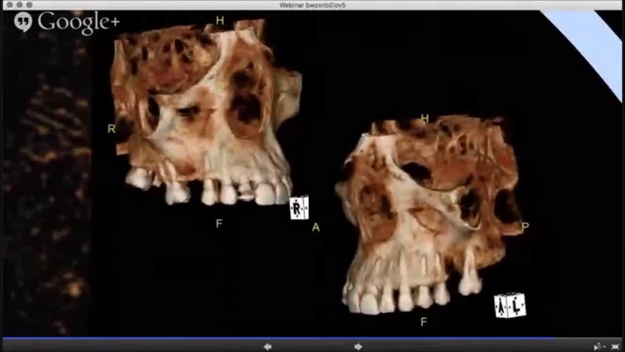 Webinar - Tomografia Computadorizada na Odontologia