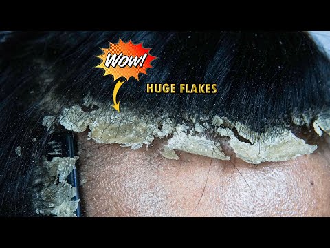 Huge Dandruff Flakes Removal #1116
