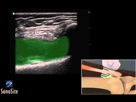 Das Armgelenk war geschwollen und wund Bandage Schultergelenk gewöhnliche Luxation