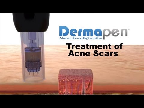 MicroNeedling for Acne Scars - Dermapen® Treatment