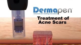 MicroNeedling for Acne Scars - Dermapen® Treatment