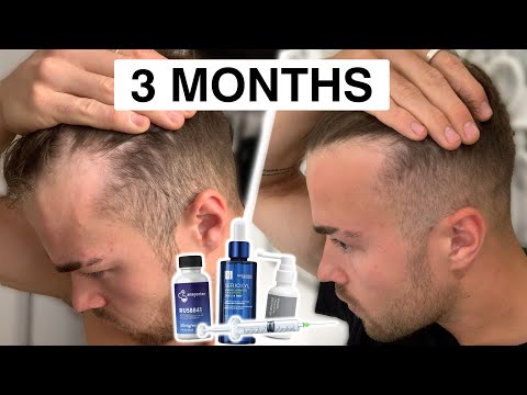 Hair Loss Prevention Stack (How I Grow My Hair)