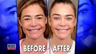 Denise Richards Undergoes Plastic Surgery By Dr. Ben Talei - Inside Edition