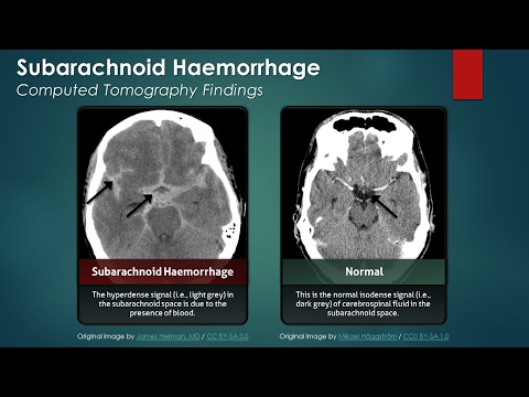 Subarachnoid Hemorrhage (SAH): Computed Tomography Scan Findings