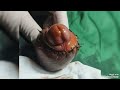 Dr Purnanto SUNAT MINYAK KEMIRI SILIKON