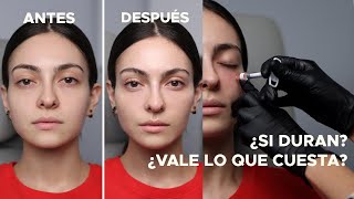 1 año después de ponerme fillers... ¿Vale la pena y el dinero invertido | Anna Sarelly