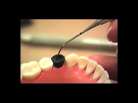 Dental Anatomy: Waxing Mandibular Premolar #20
