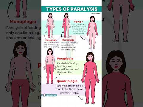 Types of Paralysis Explained | Monoplegia vs Hemiplegia vs Paraplegia