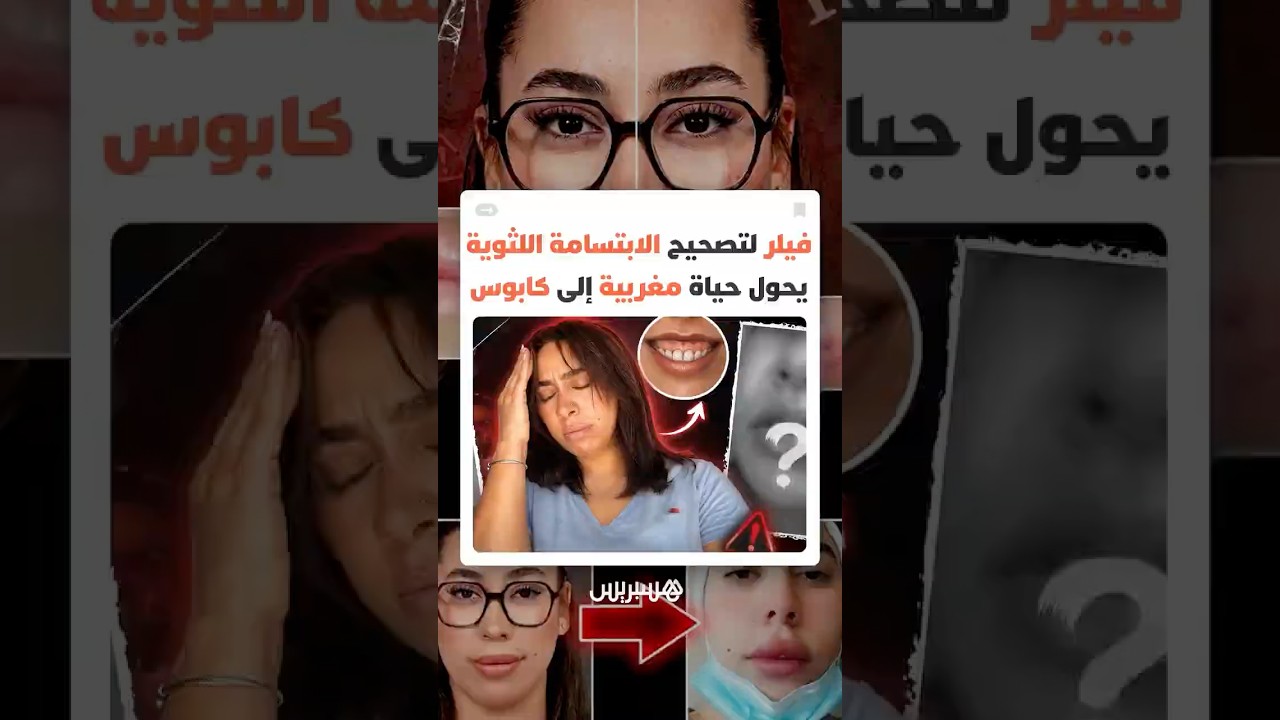 Gummy Smile" تتحول إلى كابوس.. شابة مغربية تكشف كيف تسبب الفيلر الخاطئ في تشوه ملامحها واعوجاج فمها thumbnail
