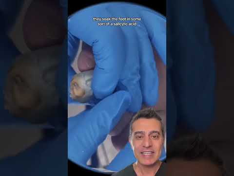 Shocking dead Skin Removal!!