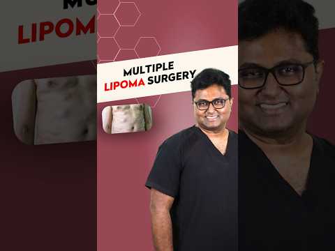 Multiple Lipoma Surgery - Dr. Karthik Ram - Chennai Plastic Surgery