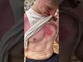 Verbrennung Zweiten Grades Auf Mallorca Shorts