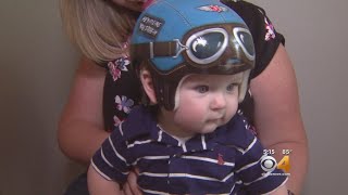 Baby Wears &#39;Aviator&#39; Helmet For Protection After Skull Surgery
