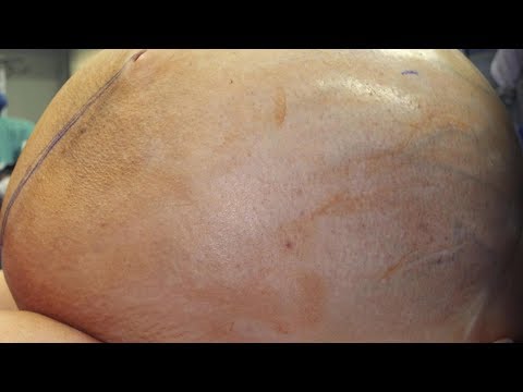 Frau wird 60 Kilo schwerer Tumor entfernt!