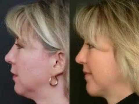 Chin Augmentation Explained