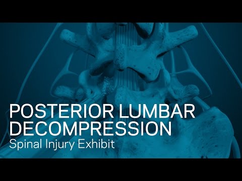 Posterior Lumbar Decompression - Spinal Injury Animation