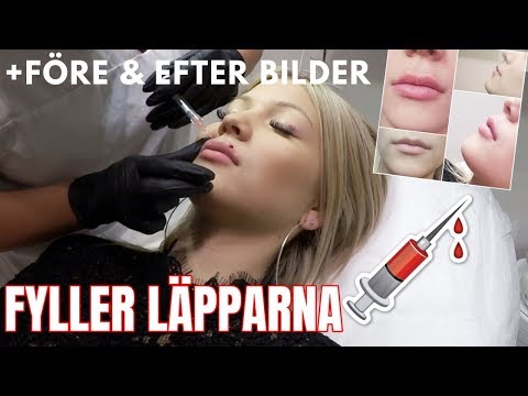Fyller läpparna // VLOGG (känsliga tittare varnas)