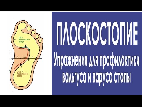 Jak rehabilitacja po operacji halyus koślawego Wkładki ortopedyczne dla dzieci zabawy Orto z palucha koślawego
