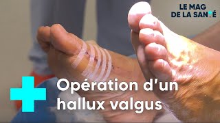 Hallux valgus : une chirurgie pour réparer le pied - Le Magazine de la Santé