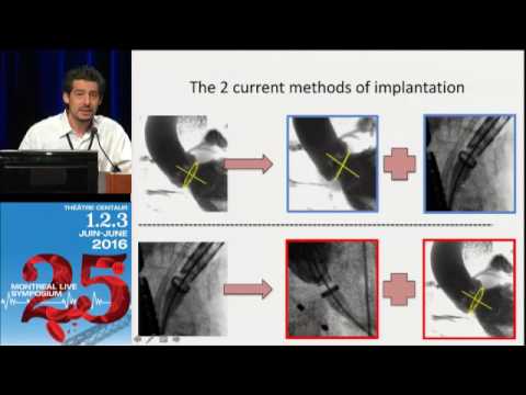 05 - State of the art Imaging for Aortic Valve Therapy - Nicolo Piazza