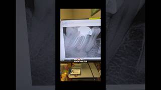 One appt endo retx with 1 year post op. #dentists #dentalexcellence #rootcanaltherapy #dental