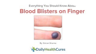 10 Home Remedies to Treat Blood Blister on Finger