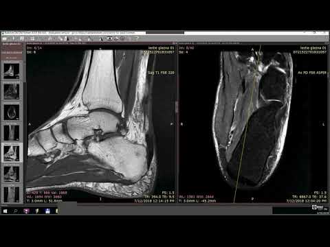 Creșterea pe articulația genunchiului
