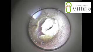 耳掃除動画vol.26「自分でやるのは怖くて…」