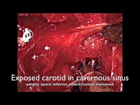 Operacja guza przysadki mózgowej - odsłonięcie tętnicy szyjnej wewnętrznej
